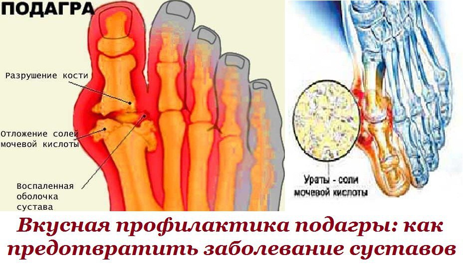 Заболевания подагра симптомы и причины